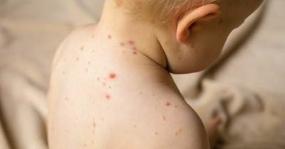 Measles 'epidemic' warning as one in 10 British kids go unvaccinated - see symptoms