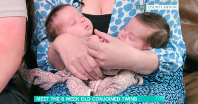 Parents welcome 'miracle' conjoined twins who are one in 2.5 million