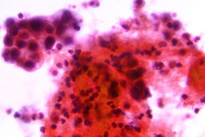 Study uncovers clues to rise in uterine cancer death rates