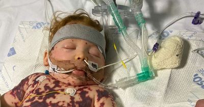 'Energetic' toddler woke up with a horror rash and is now set to lose fingertips and toes