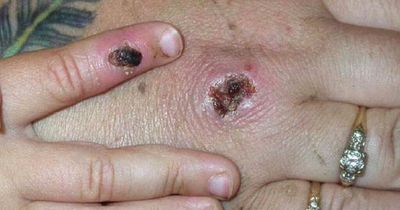 Monkeypox symptoms - eight signs to look for as virus confirmed in UK