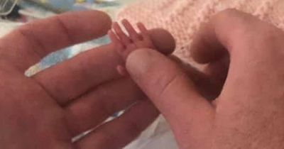‘Miracle’ tiny baby born at just 23 weeks had hands the size of her dad’s fingernail