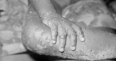 What is monkeypox - symptoms of virus spread by wild animals after UK case found