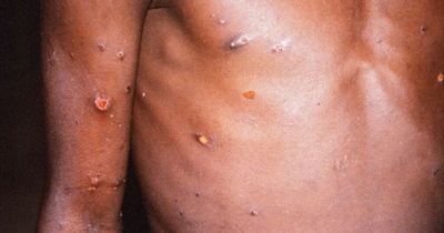 Monkeypox symptoms - how do you catch it and what does rash look like?