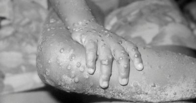 Seven key symptoms of Monkeypox to look out for after case confirmed in UK