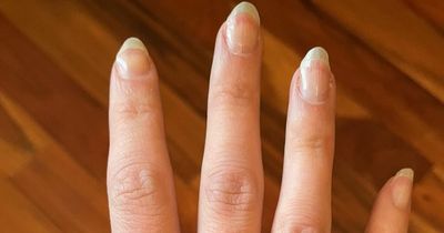 Signs of cancer that you can see on your fingernails