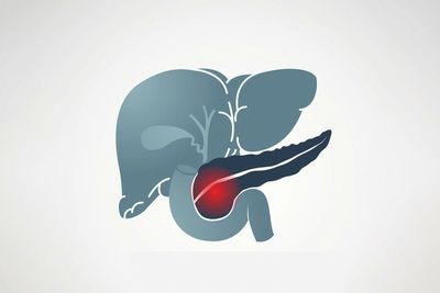 Pancreatic cancer is almost impossible to detect early