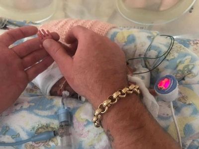 Premature baby born at 23 weeks with hand size as father’s fingernail