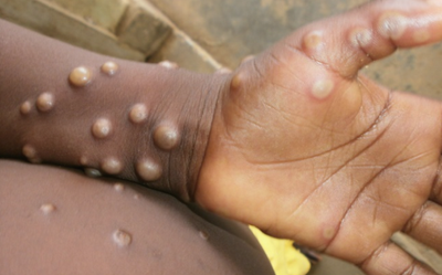 Explained | What is the monkeypox virus and how is it transmitted?