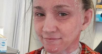 Scots mum's eczema cream hell left skin so bad strangers took pictures behind her back