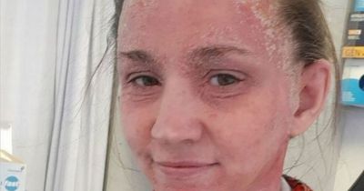 Devastated Scottish mum says strangers stop to take pictures of her skin