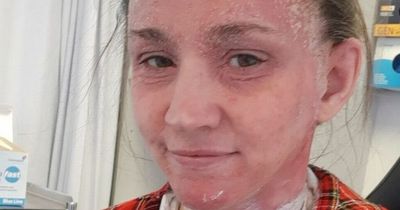 Mum's eczema hell left skin so bad strangers took pictures behind her back