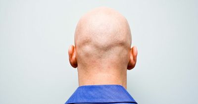 Calling a man 'bald' is considered sexual harassment, tribunal rules