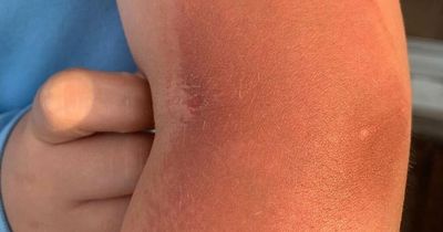 Boy suffers nasty burn after leaning on telegraph pole and scorching his skin