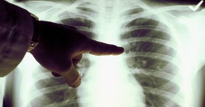 Lung cancer patients to get new drug which can double life-expectancy