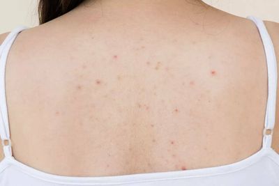 How to get rid of body acne