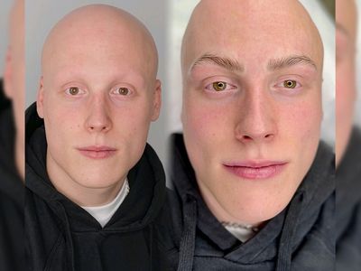 Student who lost his hair from GCSE stress reveals the beauty treatment that brought his confidence back