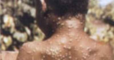 Monkeypox alert as 4 new cases found in England - and none have links to Africa travel