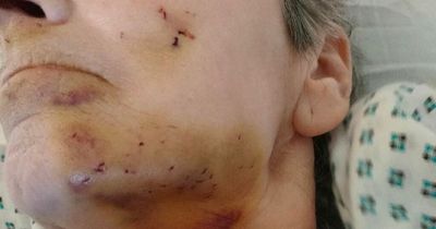 Woman 'savagely' attacked by rat that 'gnawed' her face as she couldn't move in her bed