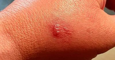 False Widow spider bite leaves 'spooked' man's arm itching and swelled for weeks