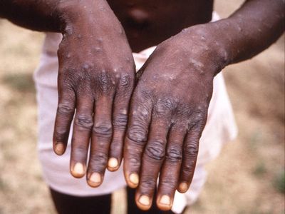 Monkeypox: Seven symptoms of virus confirmed in UK