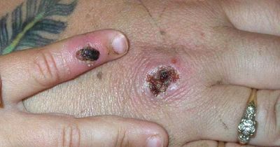 Monkeypox virus symptoms, causes and what to do if you suspect you have it
