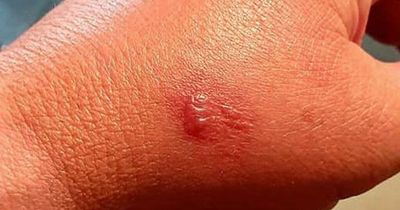 UK's most venomous spider leaves man itching for weeks after pouncing in back yard