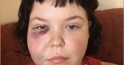 Gardai probing 'homophobic attack' in Dublin after lesbian couple suffer horrific injuries