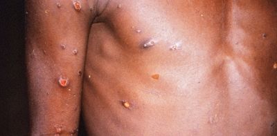 European outbreak of monkeypox: what you need to know