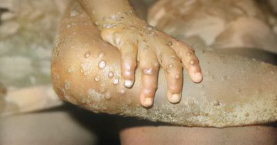 Monkeypox outbreak is now largest ever seen in Europe - urgent hunt for source