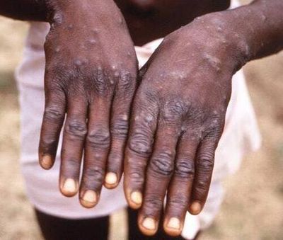 What fresh hell is monkeypox?