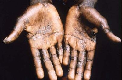 Monkeypox cases likely to be ‘more widespread’ than originally thought