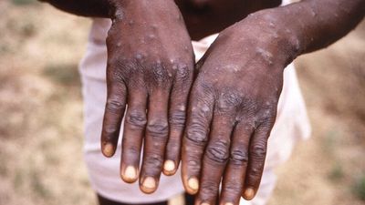 Monkeypox confirmed in Melbourne and Sydney