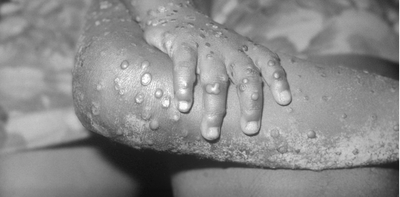 Monkeypox in Australia: what is it and how can we prevent the spread?