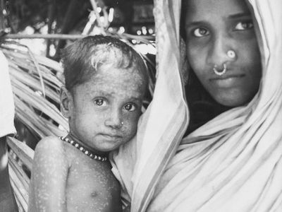 How Rahima came to hold a special place in smallpox history — and help ensure its end
