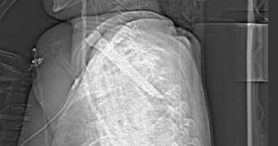 Horrifying X-ray shows 14cm knife blade lodged in man's throat - but he survived
