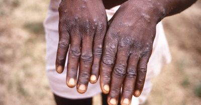 UK monkeypox cases double as WHO plans emergency meeting over outbreak