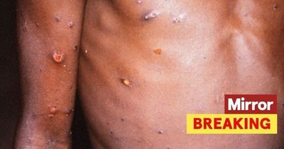 UK monkeypox cases double in a DAY as disease spreads across the globe