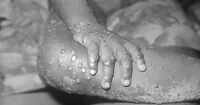 Monkeypox cases in UK more than double to 20