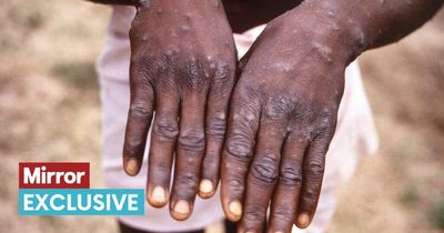 Monkeypox virus spreads across world - symptoms and how worried we should be