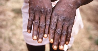 Monkeypox cases in UK more than double