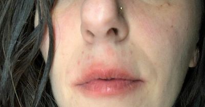 Mum left allergic and breaking out in hives at SMELL of meat after bug bite years ago