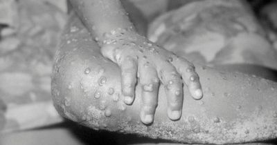 Monkeypox cases in the UK rise by more than double in last 48 hours