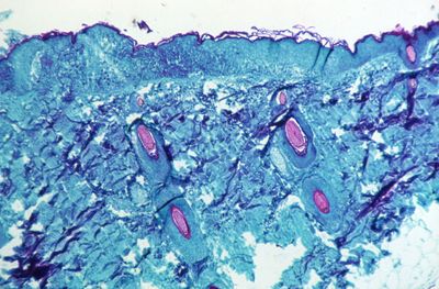 WHO calls emergency meeting as monkeypox cases top 100 in Europe