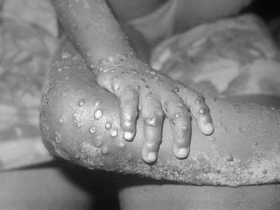 Analysis: Should You Be Afraid Of A Monkeypox Pandemic?