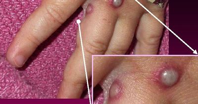 Urgent hunt under way for source of current monkeypox outbreak now largest ever seen in Europe