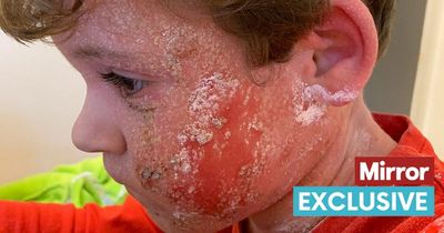 Boy, 5, left covered in blood every night as extreme eczema leaves him in agony