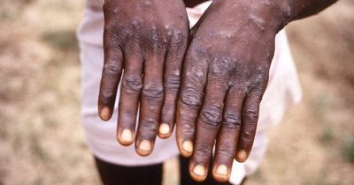 Monkeypox could have 'massive impact' on sexual health services, doctor warns