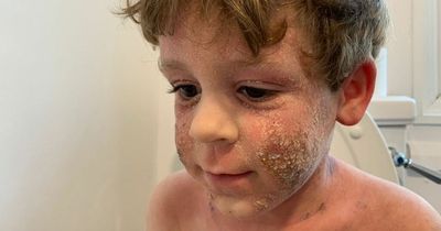 Five-year-old boy's severe eczema leaves him covered in blood and in agony