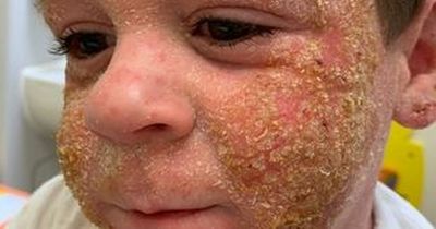 Boy, 5, left covered in blood daily as extreme eczema case leaves him in agony